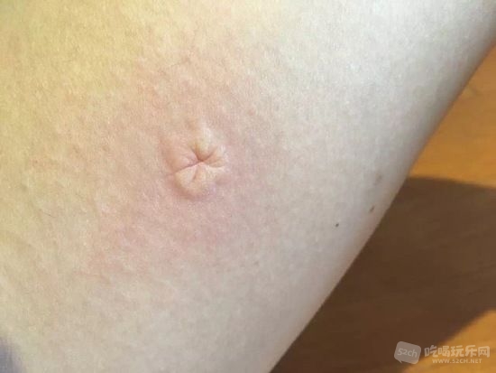 一朋友被蚊子咬了后··她脑洞大开，决定对这个蚊子包做点什么……