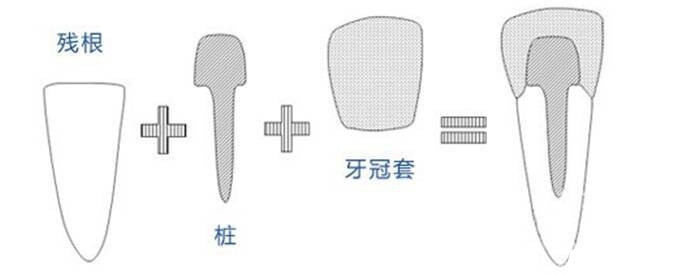 牙桩.jpeg